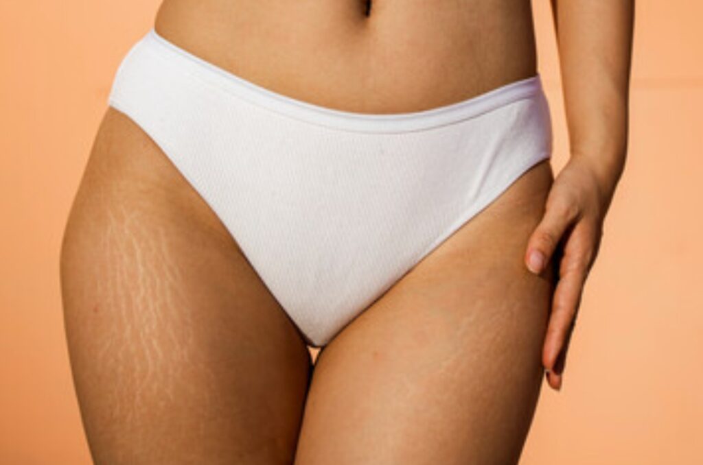 Stretch marks! How to deal with them?